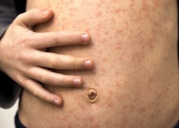 Confirmaron en CABA un caso de sarampión importado desde Medio Oriente