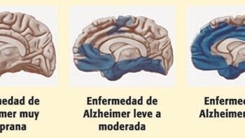 Seis señales previas de demencia que pueden manifestarse años antes del diagnóstico
