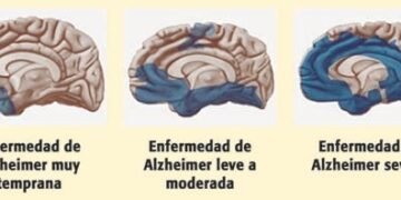 Seis señales previas de demencia que pueden manifestarse años antes del diagnóstico