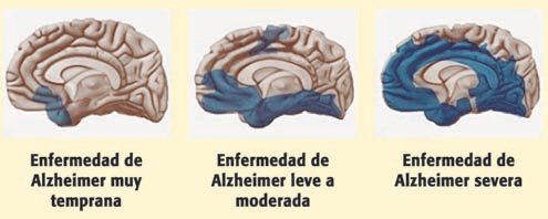 Seis señales previas de demencia que pueden manifestarse años antes del diagnóstico